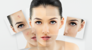 Ορμονικές Δυσλειτουργίες, Λιπαρό Δέρμα, Ακμή & Υπερτρίχωση στις Γυναίκες: Αντιμετωπίστε την Αιτία