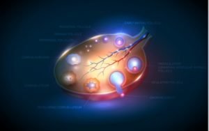 Σύνδρομο Πολυκυστικών Ωοθηκών