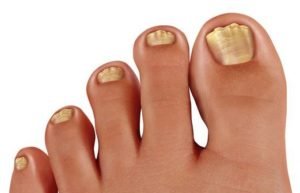 Μύκητες νυχιών: 8 συμβουλές για να μην έχετε ποτέ πρόβλημα