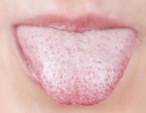 Τι μπορεί να είναι τα κόκκινα σημάδια στη γλώσσα