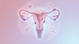 Ενδομητρίωση και Γονιμότητα: Σύγχρονη Διάγνωση και Θεραπεία