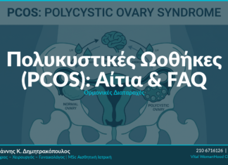 Πολυκυστικές Ωοθήκες (PCOS): Αίτια & FAQ