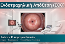 Ενδοτραχηλική Απόξεση (ECC) Ενδοτραχηλική Απόξεση (ECC) — Δρ. Δημητρακόπουλος Γλυφάδα