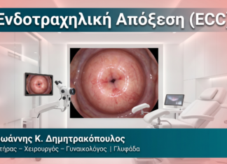 Ενδοτραχηλική Απόξεση (ECC) Ενδοτραχηλική Απόξεση (ECC) — Δρ. Δημητρακόπουλος Γλυφάδα