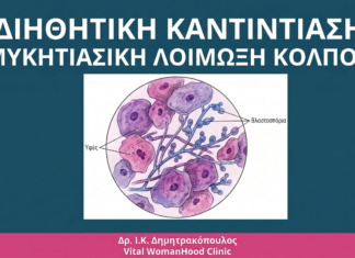 Καντιντίαση: Μυκητιασική Λοίμωξη Κόλπου