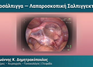 Υδροσάλπιγγα — Λαπαροσκοπική Σαλπιγγεκτομή Υδροσάλπιγγα — Λαπαροσκοπική Σαλπιγγεκτομή — Δρ. Δημητρακόπουλος Γλυφάδα