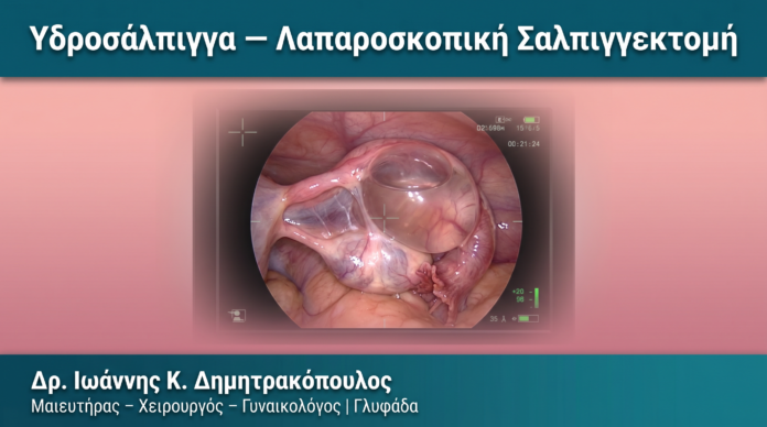 Υδροσάλπιγγα — Λαπαροσκοπική Σαλπιγγεκτομή Υδροσάλπιγγα — Λαπαροσκοπική Σαλπιγγεκτομή — Δρ. Δημητρακόπουλος Γλυφάδα