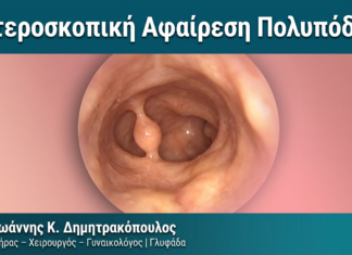Υστεροσκοπική Αφαίρεση Πολυπόδων — Δρ. Δημητρακόπουλος Γλυφάδα