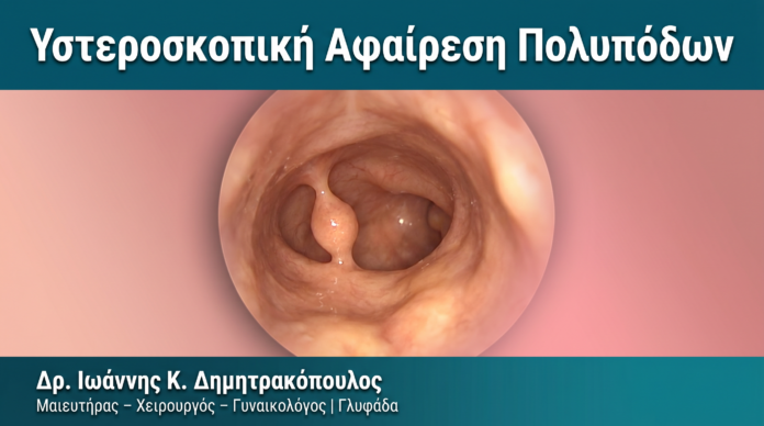 Υστεροσκοπική Αφαίρεση Πολυπόδων — Δρ. Δημητρακόπουλος Γλυφάδα