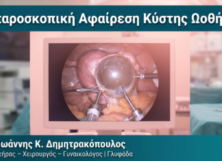 Λαπαροσκοπική Αφαίρεση Κύστης Ωοθήκης Λαπαροσκοπική Αφαίρεση Κύστης Ωοθήκης — Δρ. Δημητρακόπουλος Γλυφάδα