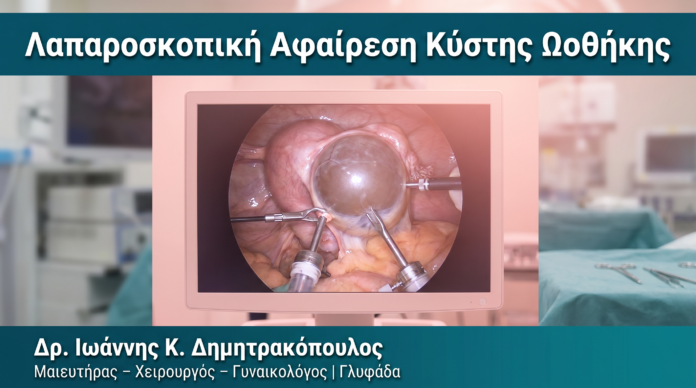 Λαπαροσκοπική Αφαίρεση Κύστης Ωοθήκης Λαπαροσκοπική Αφαίρεση Κύστης Ωοθήκης — Δρ. Δημητρακόπουλος Γλυφάδα
