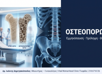 Οστεοπόρωση στη Γυναίκα: Ερωτήσεις & Απαντήσεις — Πρόληψη και Θεραπεία