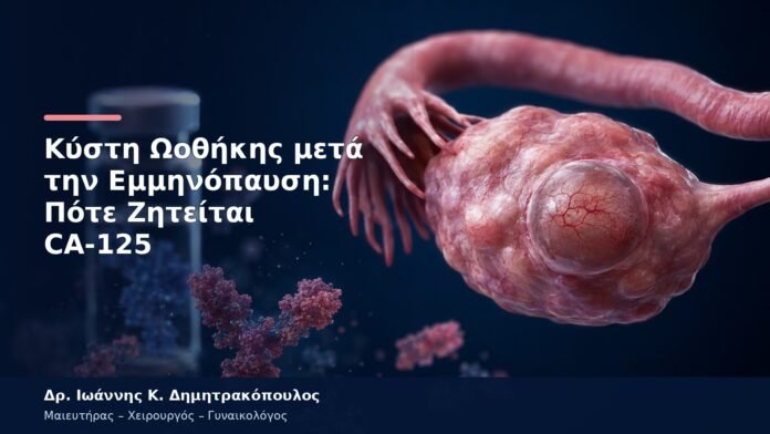 Κύστη Ωοθήκης μετά την Εμμηνόπαυση: Πότε Ζητείται CA-125