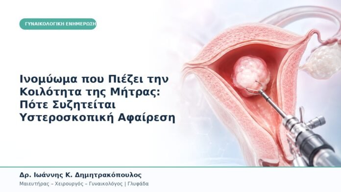 Ινομύωμα που Πιέζει την Κοιλότητα της Μήτρας: Πότε Συζητείται Υστεροσκοπική Αφαίρεση Ινομύωμα που Πιέζει την Κοιλότητα της Μήτρας: Πότε Συζητείται Υστεροσκοπική Αφαίρεση