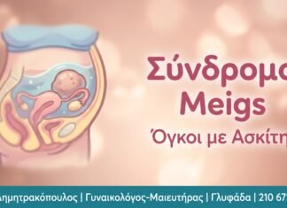 Σύνδρομο Meigs: Αίτια, Συμπτώματα και Θεραπεία