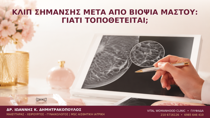 Κλιπ Σήμανσης μετά από Βιοψία Μαστού: Γιατί Τοποθετείται; - Δρ. Ιωάννης Κ. Δημητρακόπουλος