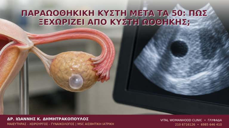 Παραωοθηκική Κύστη μετά τα 50: Πώς Ξεχωρίζει από Κύστη Ωοθήκης; - Δρ. Ιωάννης Κ. Δημητρακόπουλος