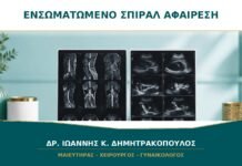 Ενσωματωμένο Σπιράλ στο Μυομήτριο: Πότε Αφαιρείται με Υστεροσκόπηση;