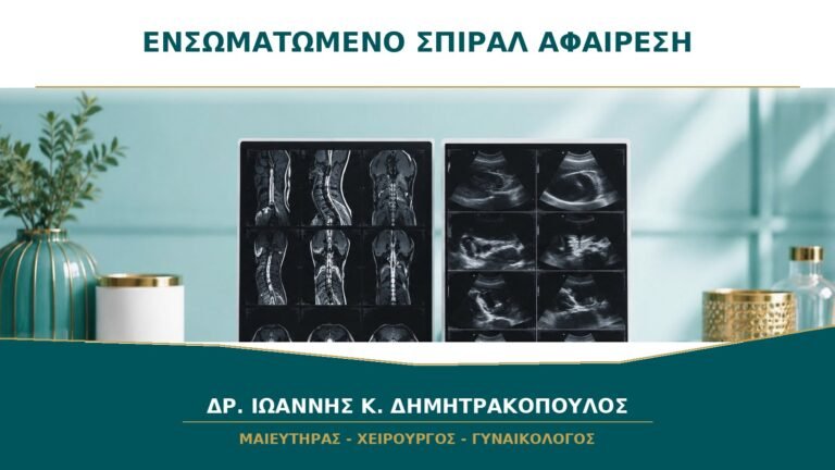 Ενσωματωμένο Σπιράλ στο Μυομήτριο: Πότε Αφαιρείται με Υστεροσκόπηση;