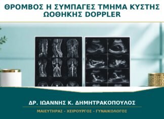 Θρόμβος Αίματος ή Συμπαγές Τμήμα μέσα σε Κύστη: Τι Δείχνει το Doppler; Θρόμβος Αίματος ή Συμπαγές Τμήμα μέσα σε Κύστη: Τι Δείχνει το Doppler;