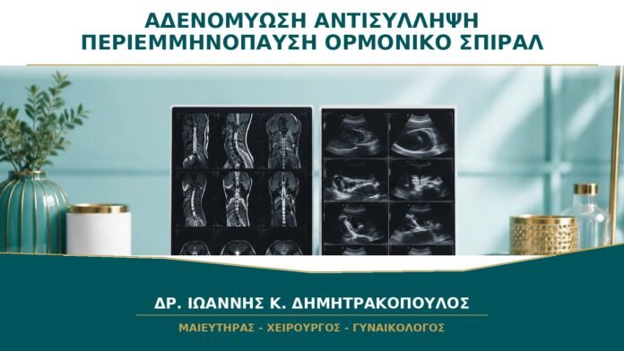Αδενομύωση και Αντισύλληψη στην Περιεμμηνόπαυση: Βοηθά το Ορμονικό Σπιράλ;