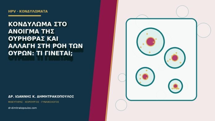 hpv-kondylomata-b80-06 Κονδύλωμα στο άνοιγμα της ουρήθρας και αλλαγή στη ροή των ούρων: τι γίνεται;