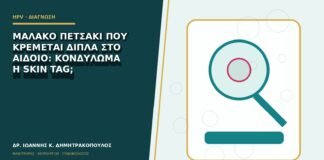 Μαλακό πετσάκι που κρέμεται δίπλα στο αιδοίο: κονδύλωμα ή skin tag;