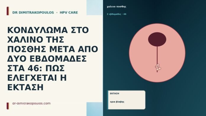 ΚΟΝΔΥΛΩΜΑ ΣΤΟ ΧΑΛΙΝΟ ΤΗΣ ΠΟΣΘΗΣ ΜΕΤΑ ΑΠΟ ΔΥΟ ΕΒΔΟΜΑΔΕΣ ΣΤΑ 46: ΠΩΣ ΕΛΕΓΧΕΤΑΙ Η ΕΚΤΑΣΗ ΚΟΝΔΥΛΩΜΑ ΣΤΟ ΧΑΛΙΝΟ ΤΗΣ ΠΟΣΘΗΣ ΜΕΤΑ ΑΠΟ ΔΥΟ ΕΒΔΟΜΑΔΕΣ ΣΤΑ
