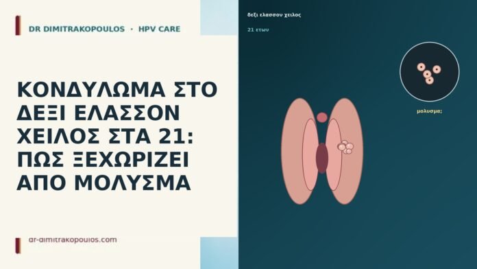 ΚΟΝΔΥΛΩΜΑ ΣΤΟ ΔΕΞΙ ΕΛΑΣΣΟΝ ΧΕΙΛΟΣ ΣΤΑ 21: ΠΩΣ ΞΕΧΩΡΙΖΕΙ ΑΠΟ ΜΟΛΥΣΜΑ ΚΟΝΔΥΛΩΜΑ ΣΤΟ ΔΕΞΙ ΕΛΑΣΣΟΝ ΧΕΙΛΟΣ ΣΤΑ 21: ΠΩΣ ΞΕΧΩΡΙΖΕΙ ΑΠΟ