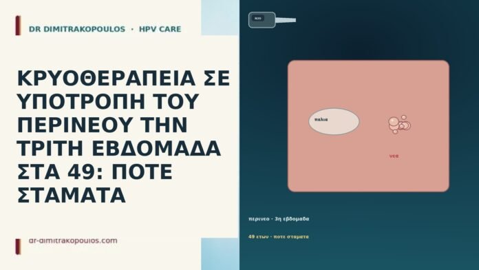 ΚΡΥΟΘΕΡΑΠΕΙΑ ΣΕ ΥΠΟΤΡΟΠΗ ΤΟΥ ΠΕΡΙΝΕΟΥ ΤΗΝ ΤΡΙΤΗ ΕΒΔΟΜΑΔΑ ΣΤΑ 49: ΠΟΤΕ ΣΤΑΜΑΤΑ ΚΡΥΟΘΕΡΑΠΕΙΑ ΣΕ ΥΠΟΤΡΟΠΗ ΤΟΥ ΠΕΡΙΝΕΟΥ ΤΗΝ ΤΡΙΤΗ ΕΒΔΟΜΑΔΑ ΣΤΑ 49: