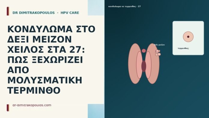 ΚΟΝΔΥΛΩΜΑ ΣΤΟ ΔΕΞΙ ΜΕΙΖΟΝ ΧΕΙΛΟΣ ΣΤΑ 27: ΠΩΣ ΞΕΧΩΡΙΖΕΙ ΑΠΟ ΜΟΛΥΣΜΑΤΙΚΗ ΤΕΡΜΙΝΘΟ ΚΟΝΔΥΛΩΜΑ ΣΤΟ ΔΕΞΙ ΜΕΙΖΟΝ ΧΕΙΛΟΣ ΣΤΑ 27: ΠΩΣ ΞΕΧΩΡΙΖΕΙ ΑΠΟ