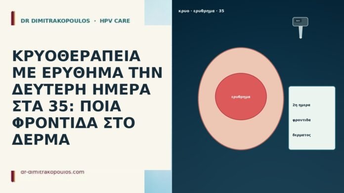 ΚΡΥΟΘΕΡΑΠΕΙΑ ΜΕ ΕΡΥΘΗΜΑ ΤΗΝ ΔΕΥΤΕΡΗ ΗΜΕΡΑ ΣΤΑ 35: ΠΟΙΑ ΦΡΟΝΤΙΔΑ ΣΤΟ ΔΕΡΜΑ ΚΡΥΟΘΕΡΑΠΕΙΑ ΜΕ ΕΡΥΘΗΜΑ ΤΗΝ ΔΕΥΤΕΡΗ ΗΜΕΡΑ ΣΤΑ 35: ΠΟΙΑ ΦΡΟΝΤΙΔΑ