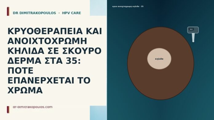 ΚΡΥΟΘΕΡΑΠΕΙΑ ΚΑΙ ΑΝΟΙΧΤΟΧΡΩΜΗ ΚΗΛΙΔΑ ΣΕ ΣΚΟΥΡΟ ΔΕΡΜΑ ΣΤΑ 35: ΠΟΤΕ