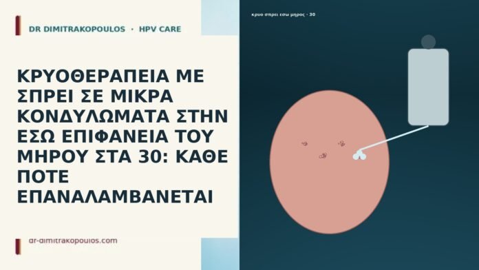 ΚΡΥΟΘΕΡΑΠΕΙΑ ΜΕ ΣΠΡΕΙ ΣΕ ΜΙΚΡΑ ΚΟΝΔΥΛΩΜΑΤΑ ΣΤΗΝ ΕΣΩ ΕΠΙΦΑΝΕΙΑ ΤΟΥ ΜΗΡΟΥ ΣΤΑ 30: ΚΑΘΕ ΠΟΤΕ ΕΠΑΝΑΛΑΜΒΑΝΕΤΑΙ ΚΡΥΟΘΕΡΑΠΕΙΑ ΜΕ ΣΠΡΕΙ ΣΕ ΜΙΚΡΑ ΚΟΝΔΥΛΩΜΑΤΑ ΣΤΗΝ ΕΣΩ ΕΠΙΦΑΝΕΙΑ ΤΟΥ