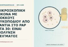 ΜΙΚΡΟΣΚΟΠΙΚΗ ΕΙΚΟΝΑ ΜΕ ΚΟΚΚΟΥΣ ΛΥΚΟΠΟΔΙΟΥ ΑΠΟ ΓΑΝΤΙΑ ΣΤΟ PAP ΣΤΑ 30: ΕΙΝΑΙ ΜΟΛΥΝΣΗ ΔΕΙΓΜΑΤΟΣ κόκκους λυκοποδίου από γάντια στο Παπ