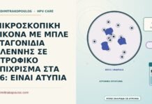 μπλε σταγονίδια σε ατροφικό επίχρισμα