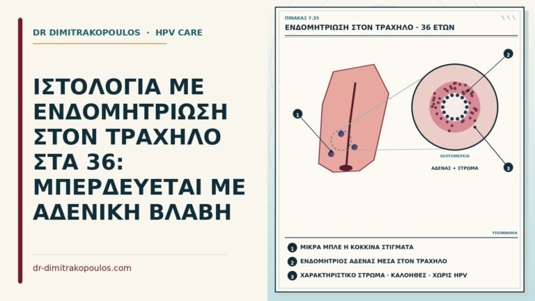 ενδομητρίωση στον τράχηλο