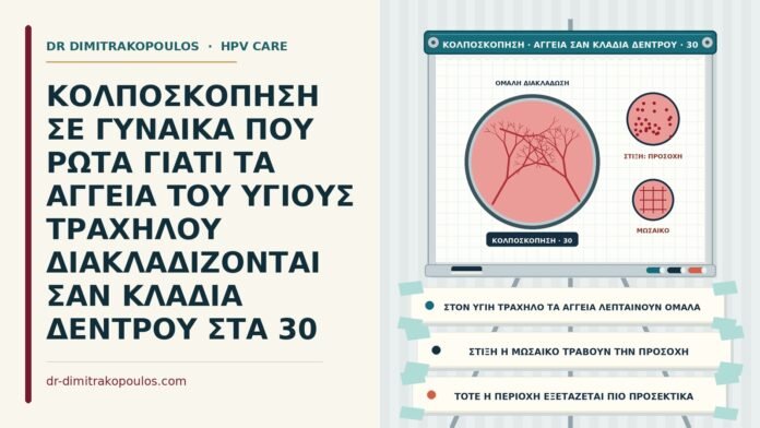 ΚΟΛΠΟΣΚΟΠΗΣΗ ΣΕ ΓΥΝΑΙΚΑ ΠΟΥ ΡΩΤΑ ΓΙΑΤΙ ΤΑ ΑΓΓΕΙΑ ΤΟΥ ΥΓΙΟΥΣ ΤΡΑΧΗΛΟΥ ΔΙΑΚΛΑΔΙΖΟΝΤΑΙ ΣΑΝ ΚΛΑΔΙΑ ΔΕΝΤΡΟΥ ΣΤΑ 30 φυσιολογικά αγγεία στην κολποσκόπηση