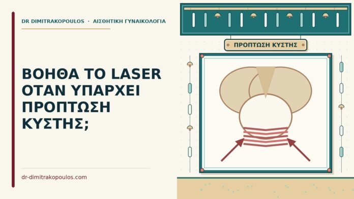 ΒΟΗΘΑ ΤΟ LASER ΟΤΑΝ ΥΠΑΡΧΕΙ ΠΡΟΠΤΩΣΗ ΚΥΣΤΗΣ; πρόπτωση κύστης
