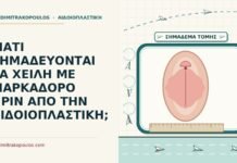 σημάδεμα με μαρκαδόρο πριν την αιδοιοπλαστική