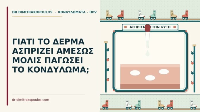 ΓΙΑΤΙ ΤΟ ΔΕΡΜΑ ΑΣΠΡΙΖΕΙ ΑΜΕΣΩΣ ΜΟΛΙΣ ΠΑΓΩΣΕΙ ΤΟ ΚΟΝΔΥΛΩΜΑ; ασπρίζει το κονδύλωμα στην κρυοθεραπεία